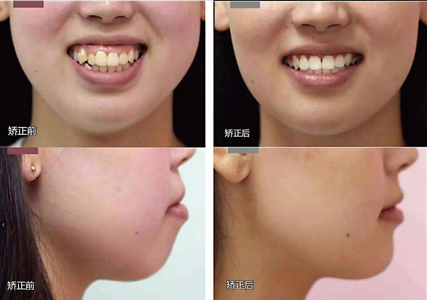 明星选择牙齿矫正,科技革新重塑自信微笑